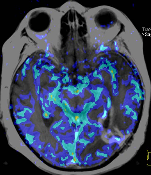 MRI 18F