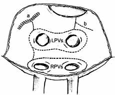 Süperior ve inferior vena kava aras na düz bir çizgi halinde ablasyon uyguland (d).