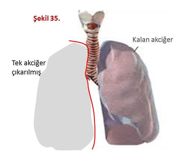 Tedavi amaçlı cerrahi yöntemler: 1. Tam plörektomi: Eğer akciğerin üstü tamamen sağlam ise, tümör adece paryetal plevrada, yani göğü duvarı üstünde ise bu yöntem uygulanır.