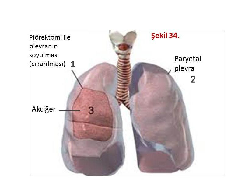 Ekstraplevral pnömonektomi: Eğer akciğer üstünde tümör parçaları varsa, bu durumda sadece göğüs duvarındaki tümörün çıkarılmasının bir anlamı olmaz, hastalığın sirayet ettiği akciğerin de alınması