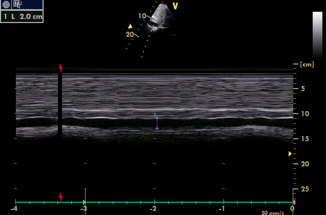 33 Şekil 3.8. IVC çapı M modla. 3.3. Elektrokardiyografi Elektrokardiyografi kontrolunda hastaların %90 ında sinus ritmi, %22 sinde PM a bağlı LBBB paterni izlendi. 3.4.