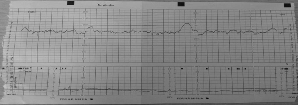 11 Şekil 2.5. Akserelasyon Trasesi Akserelasyon Deselerasyonlar, fetal kalp atımlarında bazal fetal kalp hızına göre 15-20 atımlık düşüşlerdir (3-7,17,32).