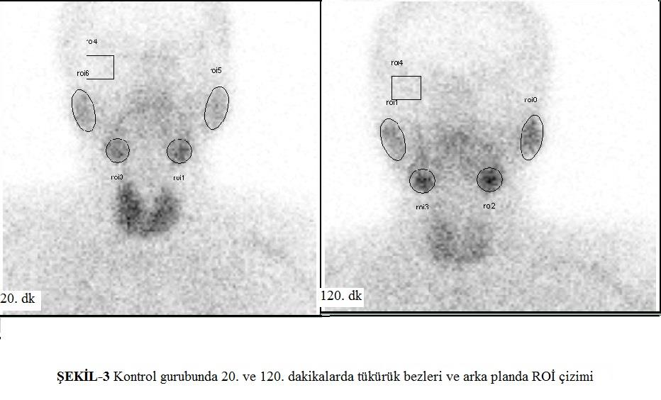 Tükürük bezlerinde Tc-99m MIBI tutulum değerleri aşağıdaki formülle hesaplandı (9). 2011 yılında Celal Bayar Üniversitesi Tıp Fakültesinden yerel etik kurul onayı alındı. T - Z.