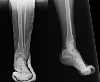 Posterior malleol kırıklarında güncel yaklaşımlar 195 (a) (b) Şekil 3. a, b. Trimalleolar kırık ön-arka ve lateral grafiler (a). İndirekt redüksiyonu takiben anteriordan posteriora vida tespiti (b).