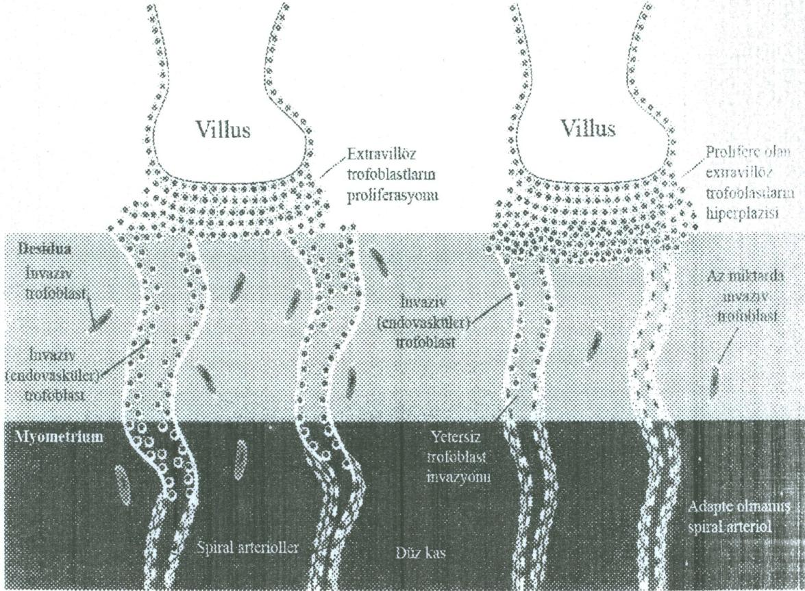 Şekil 2.1. Plasentasyon aşamasındaki trofoblast invazyonu Sol tarafta izlenen normal trofoblast invazyonuna karşılık, sağ tarafta izlenen inkomplet trofoblast invazyonu.
