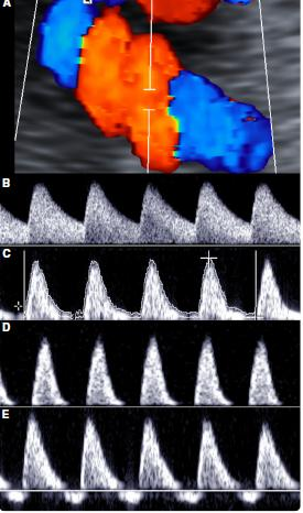 trofoblast invazyonundaki başarısızlık uterin arter vasküler rezistansında artış ve plasental perfüzyonda azalma ile sonuçlanır. Preeklampsi ve/veya IUGR sıklıkla takiben gelişir. 26.