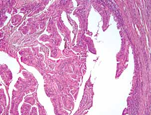 Metastatik Meme Kanserlerinde GCDFP-15, ALA, SK7 ve SK20 Boyanma Özellikleri Staining Features of GCDFP-15, ALA, CK7, and CK20 in Primary and Metastatic Breast Cancers Sinovyal