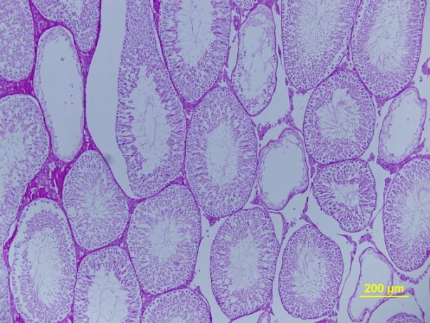 Kırmızı Yıldız(*): yaygın nekrotik seminifer tübül, mavi ok: spermatogonia A, siyah ok: