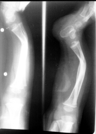 Güner G, et al. Congenital angular deformities of the leg ;5D\ GH VRO WLELD RUWDGLVWDO ELOHúNHGH derecelik anterolateral angulasyon ölçüldü.