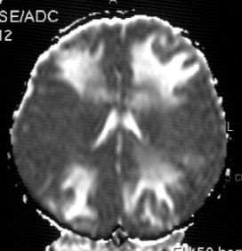 15 gün sonra çekilen takip MRG incelemede, lezyonların hemen hemen kaybolduğu ancak sağ oksipital, posterior frontal ve parietalde kortikal sinyal artışlarının ortaya çıktığı izlenmekteydi (Resim
