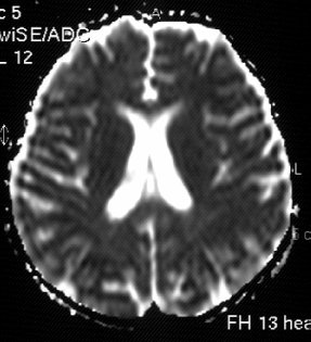 T1A (b) aksiyel görüntülerde, sağ oksipital, parietal ve bilateral posterior frontal kortikal sekel hemorajik odaklar dikkati çekmektedir.