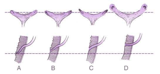 Şekil 2. Üreteral orifislerin normal ve anormal konfigürasyonları (Üst, endoskopik görünüm Alt, intramüral üreterin sagittal kesiti) 5 Kalıcı böbrekler 9-12.