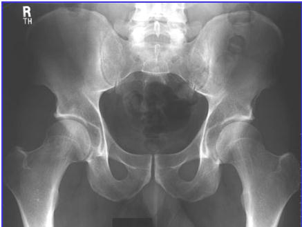 Pelvis Radyografilerinde Anatomik Yapı Pelvis A-P