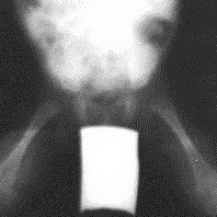 25: Her iki kalça eklemi lateral radyogramı ve Ģeması