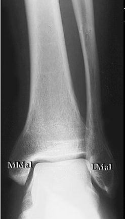Ayak Bileği Radyografilerinde Anatomik