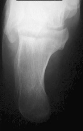 41: Ayak medial oblik radyogramı Calcaneus