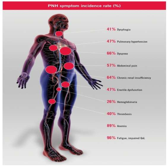 PNH, Kronik Hemolizin İlerleyici Hastalığıdır PNH Semptomu İnsidans Oranı (%) %41 Disfaji 1 %47 Pulmoner Hipertansiyon 2 %66 Dispne 1 %57 Abdominal Ağrı 1 %64 Kronik Böbrek Yetmezliği 3 %47 Erektil