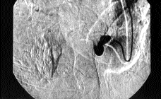 Sað bronþiyal arteriyografide, bronþiyal arterde geniþleme, tortüozite