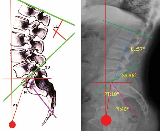 derecedir. Sonuç olarak omurgada normal bir denge için pelvik tilt, pelvik insidansın yarısından küçük, sakral slope ise pelvik insidansın yarısından büyük olmalıdır.