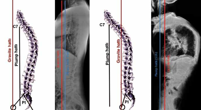 Kaynaklar Şekil 7: Pelvisin omurgayla ilişkisini belirleyen parametrelerden biri de T1 in ön yüzünden sakrumun ortasına çizilen hat ile sakrumun platosundan geçen hat arasında kalan spinosakral