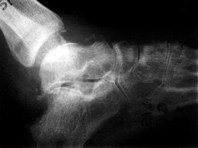 Öyküsünden 11 ay önce geçirdiði trafik kazasý sonrasý L1 vertebra patlama kýrýðý ile birlikte parapleji geçirdiði ve baþka bir hastanede anterior dekompresyon ve posterior enstrümantasyon uygulandýðý