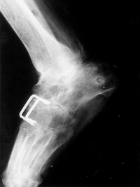 212 212 ARTROPLASTÝ ARTROSKOPÝK CERRAHÝ / JOURNAL OF ARTHROPLASTY & ARTHROSCOPIC SURGERY Resim 5: Mid tarsal osteotomi yapýlmýþ ayaðýn son kontroldeki radyolojik görüntüsü.