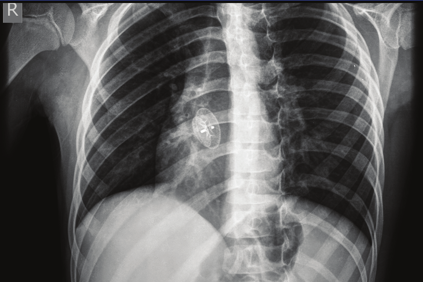 Pektus ekskavatum olması (1-3). Telekardiyografi filminde kapatma cihazı, stent, pace ve implantable kardiyak defibrilatör gibi cihazlar da görülebilir (Resim 5-8).