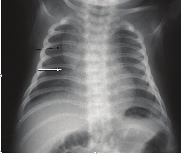 Resim 8: Hipertrofik kardiyomiyopatili bir hastada implantable kardiyak defibrilatör (ICD) görüntüsü.