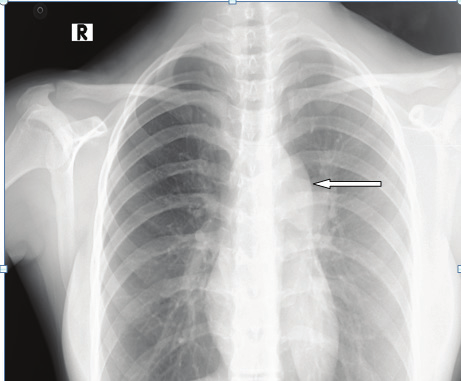 vaskülarite azalmıştır. Hilus ve pulmoner damarlar küçük, akciğerler ise normalden daha siyah renkte görülür (Resim 19).