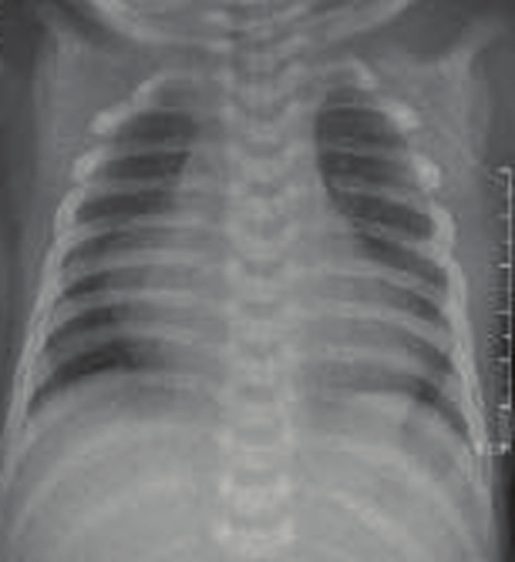Resim 18: Tele filminde kardiyomegali ve akciğer