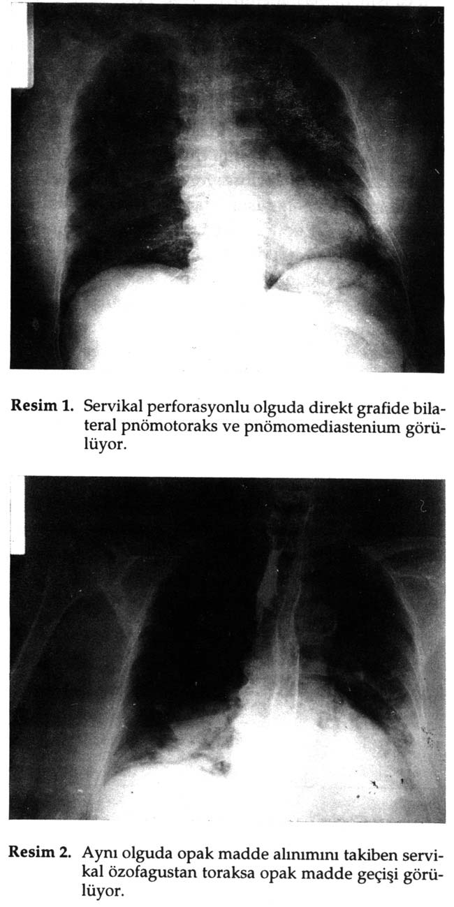 Özofagus perforasyonları nadir görülen ancak son yıllarda gelişen invaziv girişimlere bağlı olarak insidansı artan, gelişen tıbbi teknoloji ve tanı yöntemlerine rağmen yüksek mortalite ile seyreden