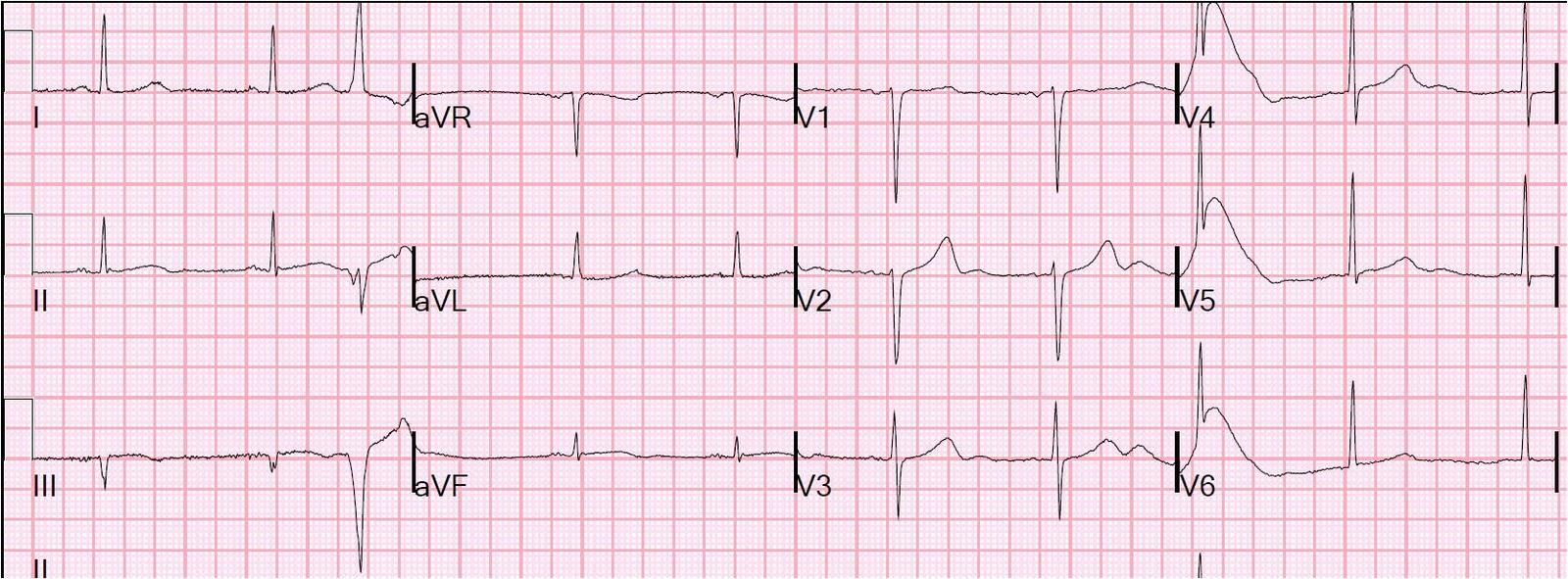 *EKG 1