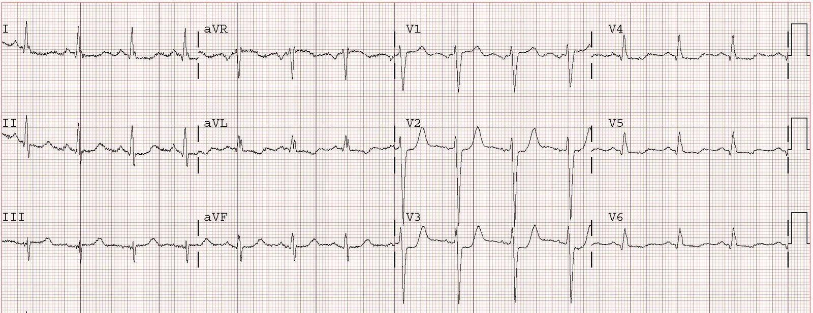 *EKG