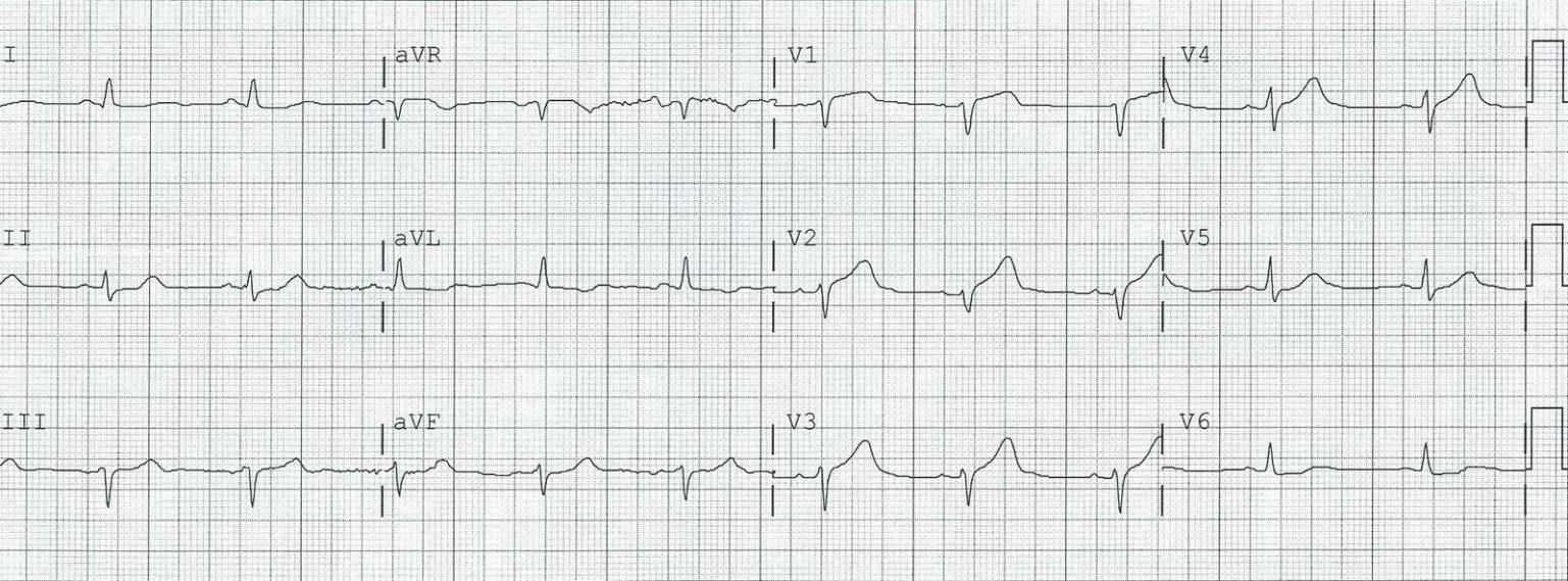 *EKG