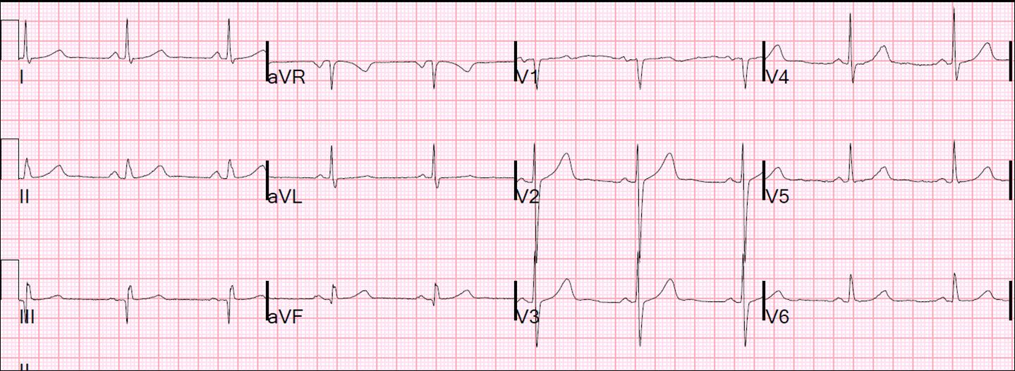 *9 ay önce çekilmiş EKG 9 ay