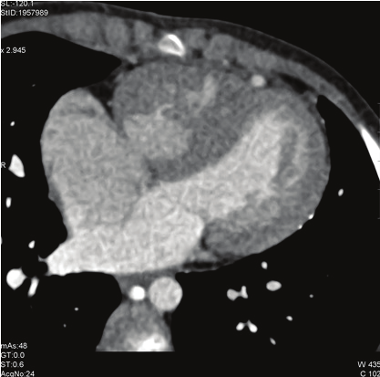 - Trunkus arteriyozus tipiv - Tek ventrikül - Total pulmoner venöz dönüş anomalisi - Triküspit atrezisi Pulmoner Kan Akımı Azalmış - Fallot tetralojisi - Pulmoner atrezi - Trunkus arteriyozus tip I -