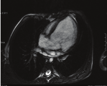 ler-mapca) bağlıdır. MRG, postoperatif prognozun ve komplikasyonların değerlendirilmesinde kullanılır.