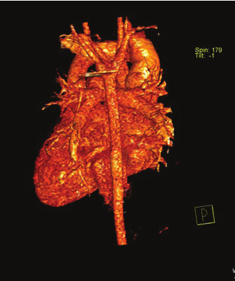 Total Pulmoner Venöz Dönüş Anomalisi Venöz dönüş anomalisi; pulmoner venlerin tamamı (total) ya da birkaçının (parsiyel), sol atriyum yerine direkt ya da büyük venler aracılığıyla (vena kava