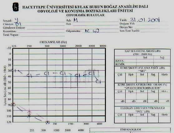 Şekil- 11: Serbest alan işitme testinde elde edilen bir sonuç Şekil- 12: Koklear implant uygulanmış bir hastanın, değişik programlardan elde ettiği kazanç miktarı 5.