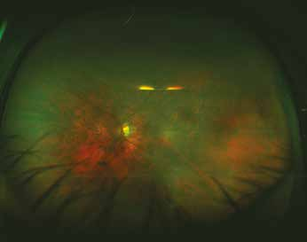 CURRENT RETINA GÜNCEL RETİNA Systems, Inc., Pleasanton, California, ABD) 1997 de kullanıma girmiştir.