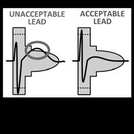 Şekil 4. QRS Kompleksini Değerlendirme 4. Alınan bütün postürlerde, tüm yüzey EKG'si kanalları ile alınan QRS komplekslerinin tümü ile yukarıdaki basamakları tekrarlayın.