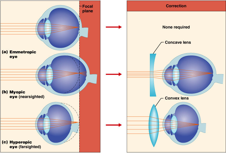 İstirahat halindeki göz paralel ışık demetlerini retinanın önünde bir yerde birleştirse bu olaya myopia denir.