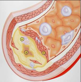 Tip IV lezyonda ekstrasellüler lipid kümeleri biraraya gelerek bir lipid çekirdek oluşturur.