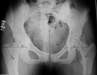 C: Salter osteotomisi sonucu, parça nötral veya mediyal