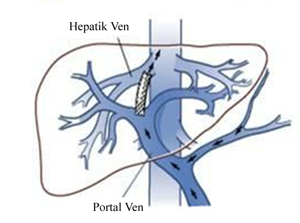 2.2. TIPS İşleminin Portal Hipertansiyon Kontrolünde Rolü TIPS; hepatik ven ile portal venin (genellikle sağ dalı) intrahepatik kısmı arasında düşük dirençli kanal oluşturularak yapılır (Şekil 2.2).