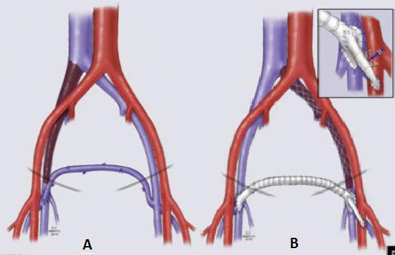 Şekil 3.5. A: Femorofemoral Safen Ven Transpozisyonu B: PTFE Greftle Femorofemoral Crossover Bypass 2.