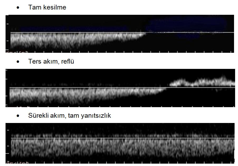 Şekil 3.2. Valsalva manevrasına yanıt olarak izlenen femoral ven Doppler traseleri 3.3. Venografi ve IVUS Venografi ameliyathanede lokal anestezi altında mobil C-kollu röntgen cihazı kullanılarak yapıldı.