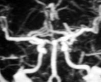 [1,8,9,13,27] ARTERYOVENÖZ MALFORMASYONLAR (AVM) ntraserebral AVM ler; kanamaya e ilimli karmafl k, k vr ml anormal damarlar n efllik etti i do ufltan anomaliler olarak karfl m za ç kmaktad r.