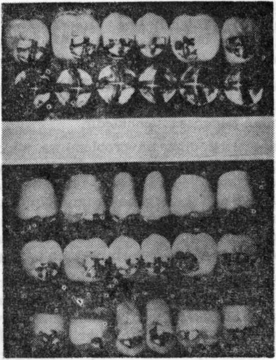 LİNGUAL KESİCİLİ DİŞLER Sosin'in çapraz kesicili dişlerinde iki büyük sakınca vardır. Bunlar, dişlerin estetik açıdan kötü görünümü ve teknik güçlüklerdir.