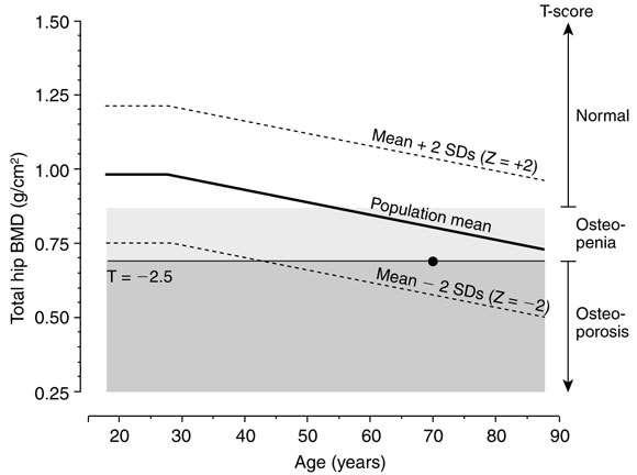 osteoporoz DEXA ölçümüyle elde edilen T-skoruna dayanıyor (T-skoru: aynı cinsten genç erişkin bireyin pik kemik kitlesine göre değerlendirme= standart sapma) YAŞLANMA WHO Tanım Kırık riski Normal